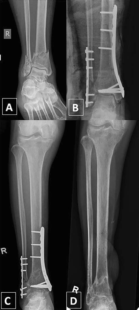 Valgus Malunion Seen In A Valgus Fracture Pattern With Medial Plating