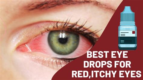 Best Allergy Eye Drops For Red Itchy Eyes Hay Fever Treatment Youtube