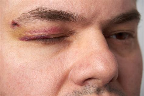 Hematoma Face Stock Photos Pictures And Royalty Free Images Istock