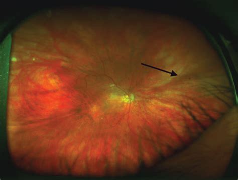 Optos Fundus Photo Shows Midperipheral Retinal Hemorrhages In The Right