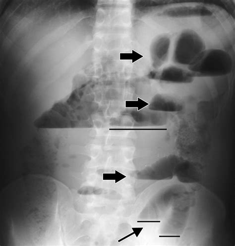 Bowel obstruction, also known as intestinal obstruction, is a mechanical or functional obstruction of the intestines which prevents the normal movement of the products of digestion. Bowel Obstruction ~ MESOTHELIOMA