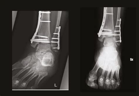 Multifragmentary Fracture Of The Distal Third Of The Tibia And Fibula