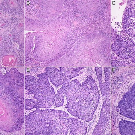 Survival Characteristics Of The Oral Cavity Squamous Cell Carcinoma