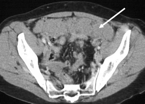 Black Spots On Ct Scan Of Abdomen And Pelvis Captions More