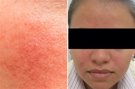Rosacea Vs Psoriasis Vs Eczema Whats The Difference The Healthy