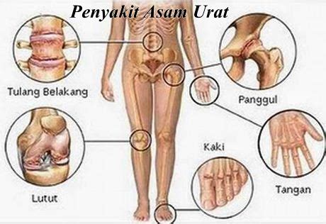 Tahapan terakhir dari penyakit asam urat adalah kronis. Mengenal Apa Itu Penyakit Asam Urat?
