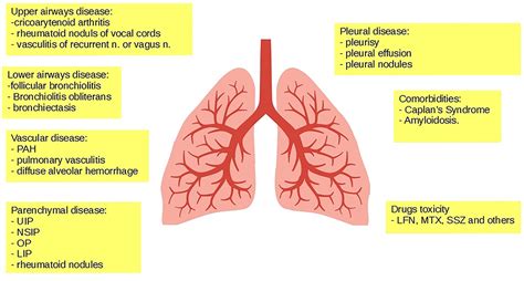 Frontiers Interstitial Lung Disease In Rheumatoid Arthritis A