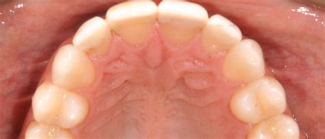 Virtual Treatment Olson Orthodontics