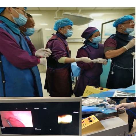 肝胆胰外科联合使用二代spyglass胆道子镜与激光碎石系统治疗一例胆总管巨大结石 中南大学湘雅三医院