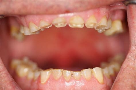 PrevenciÓn ¿cómo Prevenir El Desgaste Dental Directorio Odontológico