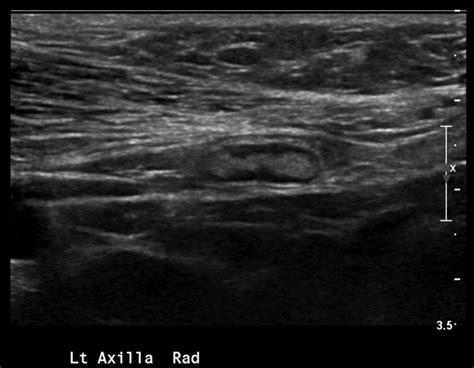 Ultrasound Images Of The Left Axilla Demonstrate A Sagittal View Of A