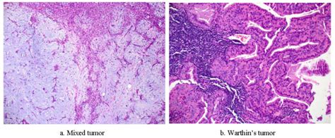 Salivary Gland Benign Tumor Pathology 200 × Download Scientific