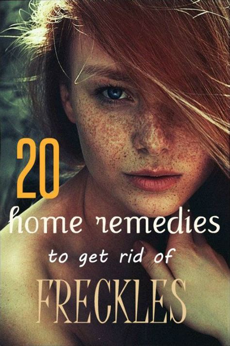 20 Superb Home Remedies To Get Rid Of Freckles Getting Rid Of