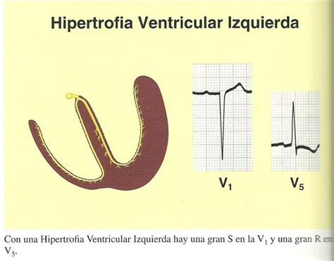 Electrocardiograma Y Medicina General Hipertrofia Ventricular Izquierda