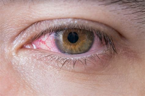How To Cure Pink Eye At Home