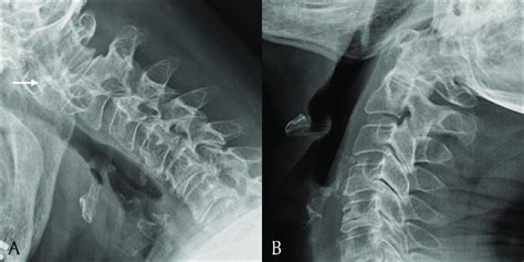 A Lateral View Of The Cervical Spine In Flexion B Lateral View Of