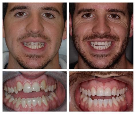 Orthodontist Surrey Invisalign Invisible Braces Surrey Mulberry Dental