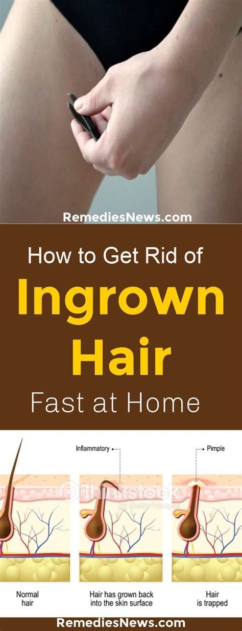How To Get Rid Of Ingrown Hair Fast At Homestop Removing The Hair In That Area Stop Wax Get
