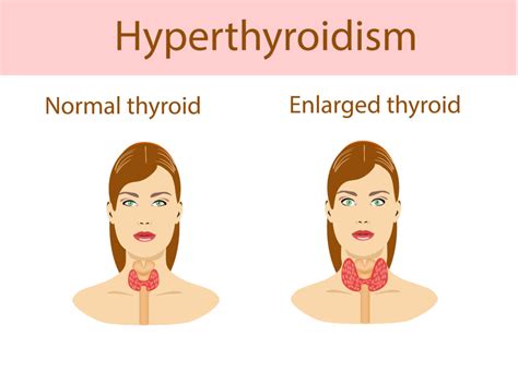 Diagnosis And Treatment Of Hyperthyroidism