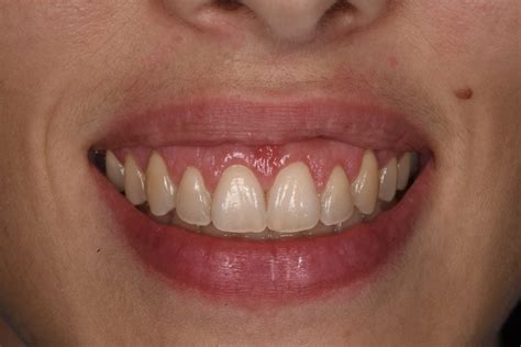 Gingival Smile Nart Clínica Dental