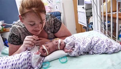 Conjoined Twins Abby And Erin Delaney A Year In The Life Pregnant Life
