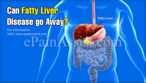 Fatty Liver Hepatic Steatosis Signs Symptoms And How To Prevent It