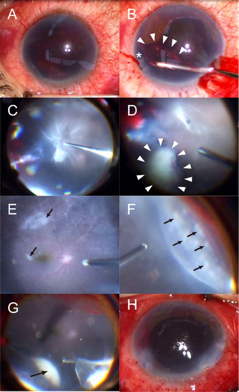 Intraoperative Images Obtained During Pars Plana Vitrectomy And
