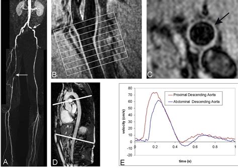 Association Between Aortic Stiffness Carotid Vessel Wall Thickness And