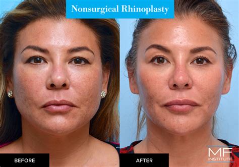 Staff Showcase See Our Own Botox® And Dermal Filler Before And After