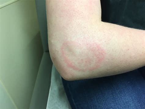 Mystery Rash What Do You Think Deets In Comments Below Lyme