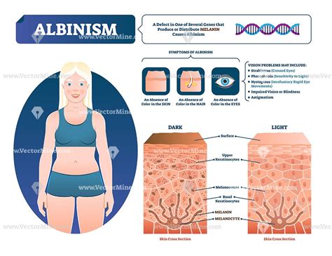 Albinism Symptoms Medical Vector Illustration Infographic Diagram The