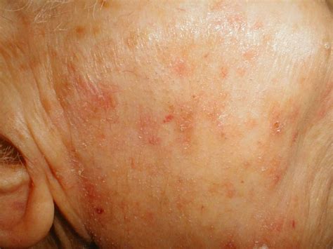 Actinic Keratosis Pictures 6 Natural Medicine Treatment Skin