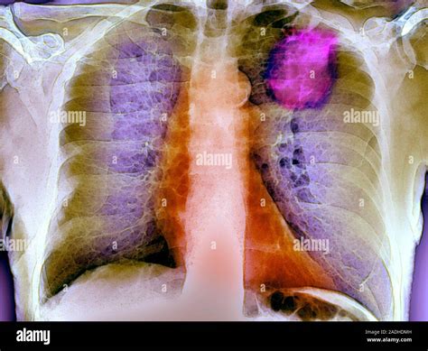 Lungenkrebs Farbige Frontal R Ntgenaufnahme Eines Gro En Tumor Lungenkrebs Bronchialkarzinom
