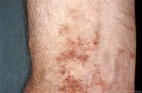 Meist liegt auch eine störung oder verringerung der. Petechiën | huidhuis.nl