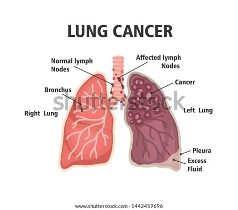 Comparison Between Healthy Lung Cancer Lung Stock Illustration