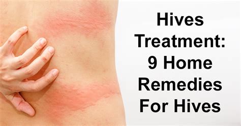 Hives Treatment 9 Home Remedies For Hives David Avocado Wolfe
