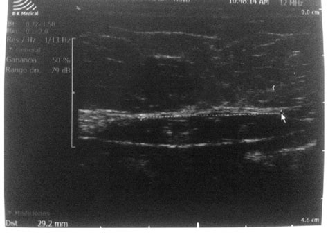 Preoperative Ultrasound 292 Mm Diastasis Recti Download Scientific