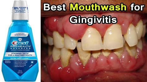 Top 3 Best Mouthwashes For Gingivitis Disease Periodontal Disease