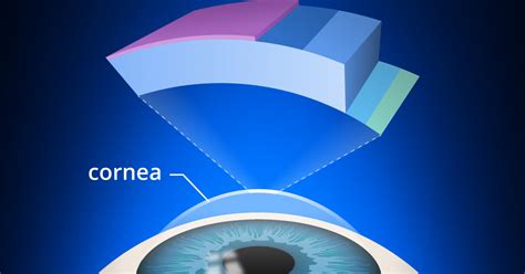 Corneal Cross Linking Recovery Side Effects Cost