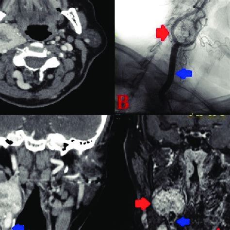 A Spiral Neck Ct Scan With Iv Contrast Shows Cbt Star Ica Red