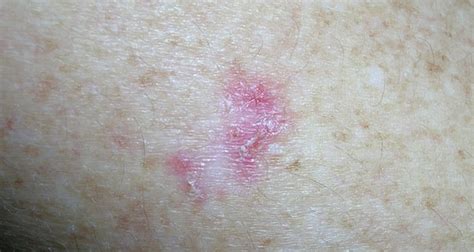 Skin Cancer Types Symptoms Melanoma And Treatment
