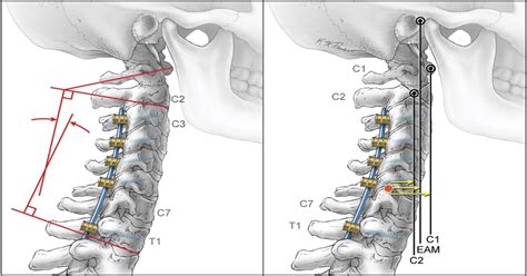 The Impact Of Standing Regional Cervical Sagittal Alignment