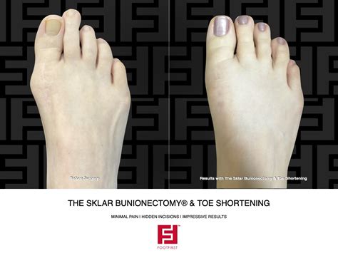 Toe Shortening Andor Toe Straightening Gallery — Foot First Podiatry