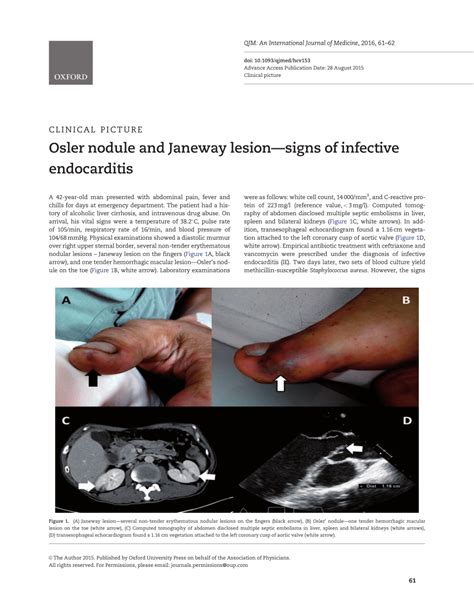 Pdf Osler Nodule And Janeway Lesion Signs Of Infective Endocarditis