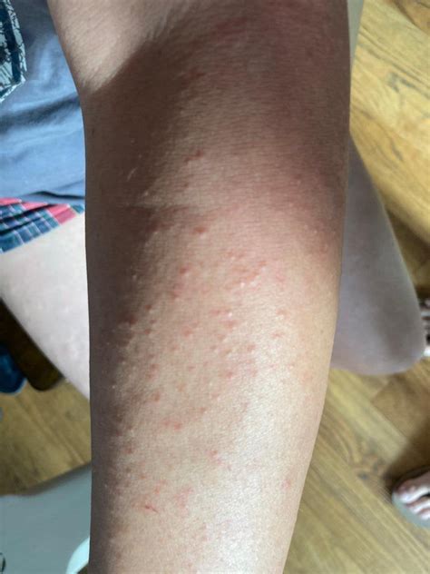 Itchy Bumps On The Skin Like Mosquito Bites Or Small Acne In Arms And