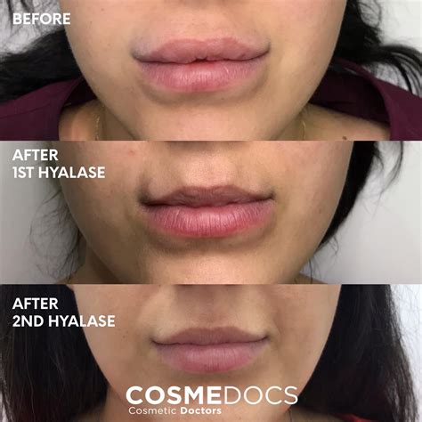 Bubbles On Lips After Fillers