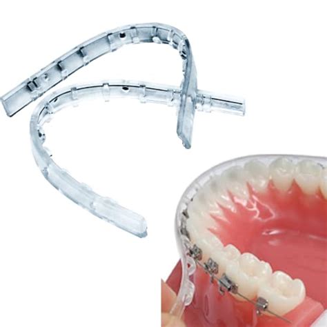 5 Benefits Of Comfort Lip Bumper Braces For A Comfortable Orthodontic