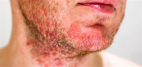Folliculitis Dermatology And Skin Health Dr Mendese
