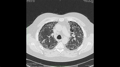 High Resolution Ct Of The Lung