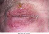 Pictures of Home Remedies Herpes Zoster